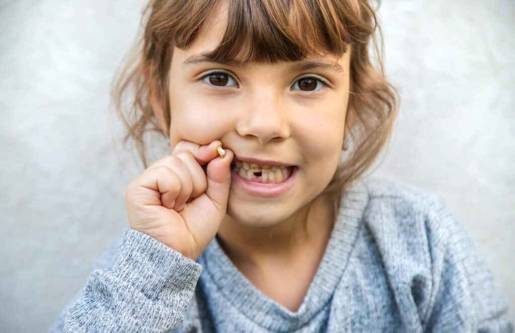 Cáries em Dentes de Leite